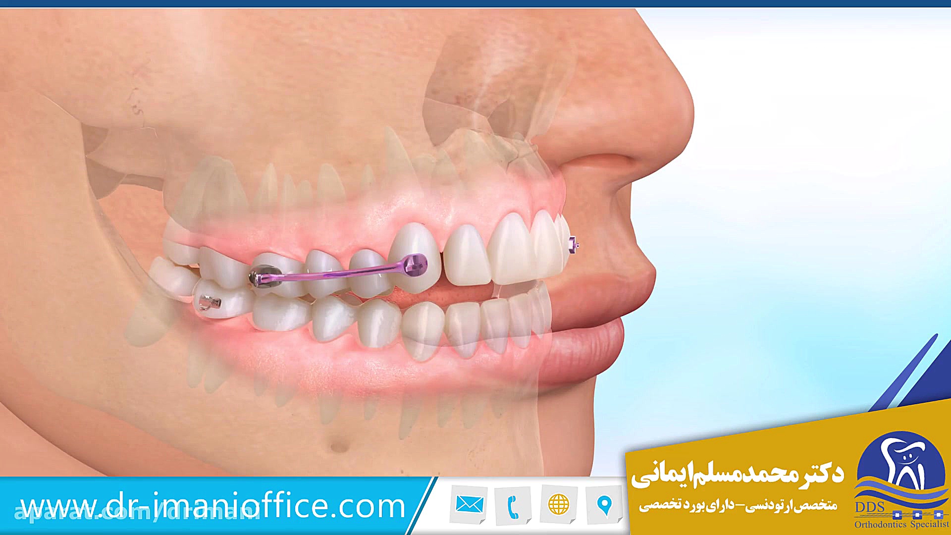 درمان ناهنجاری فک کلاس 2 اپن بایت دکتر محمد مسلم ایمانی - متخصص ارتودنسی در کرمانشاه