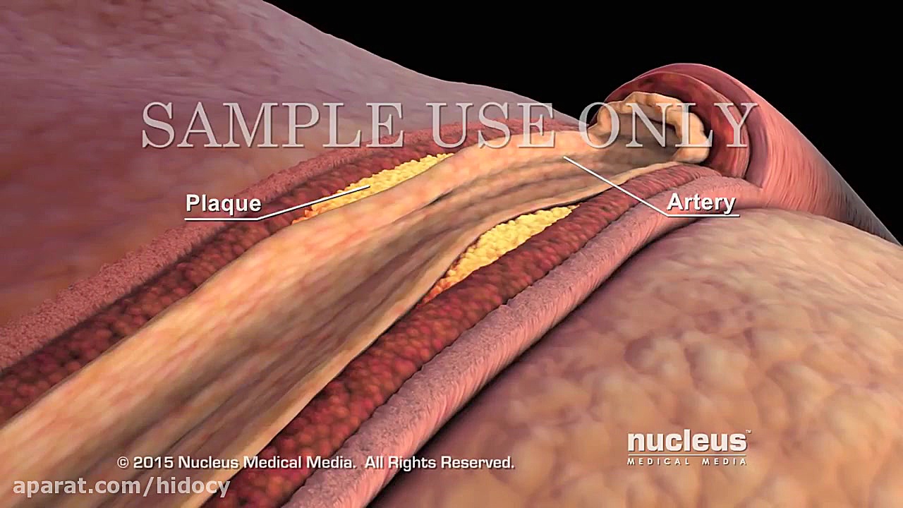 1-2 LDL و HDL کلسترول-کلسترول های خوب وبد (مجموعه انیمیشن 3D آموزش پزشکی نکلئوس) لیفت صورت