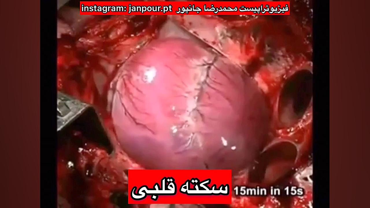سکته قلبی انسان!مرکز دکتر ارتوپد،طب فیزیکی و توانبخشی،فیزیوتراپی09122655648 دندان شیری
