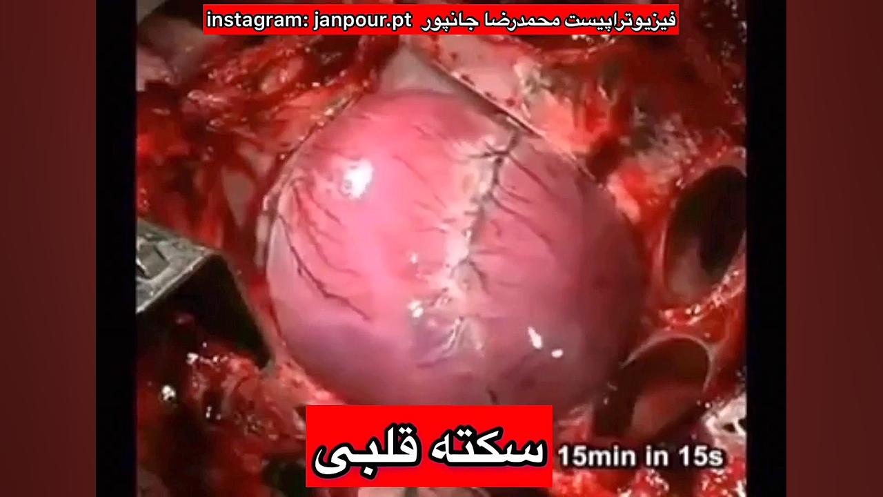 سکته قلبی انسان!مرکز متخصص ارتوپد،طب فیزیکی و توانبخشی تهران 09122655648 آر اف فرکشنال