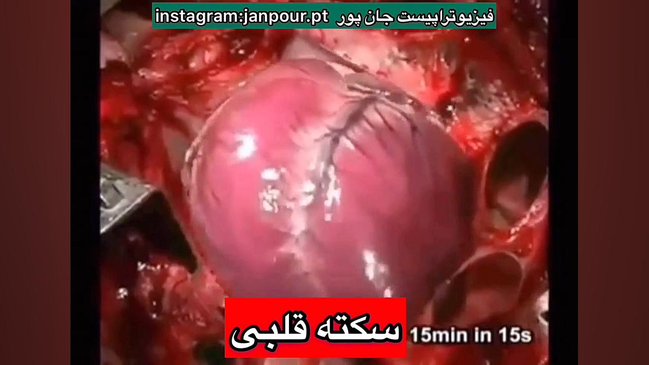 کلیپ سکته قلبی.کلینیک فیزیوتراپی در میدان رسالت،مجیدیه شمالی و جنوبی09122655648 کاشت مو