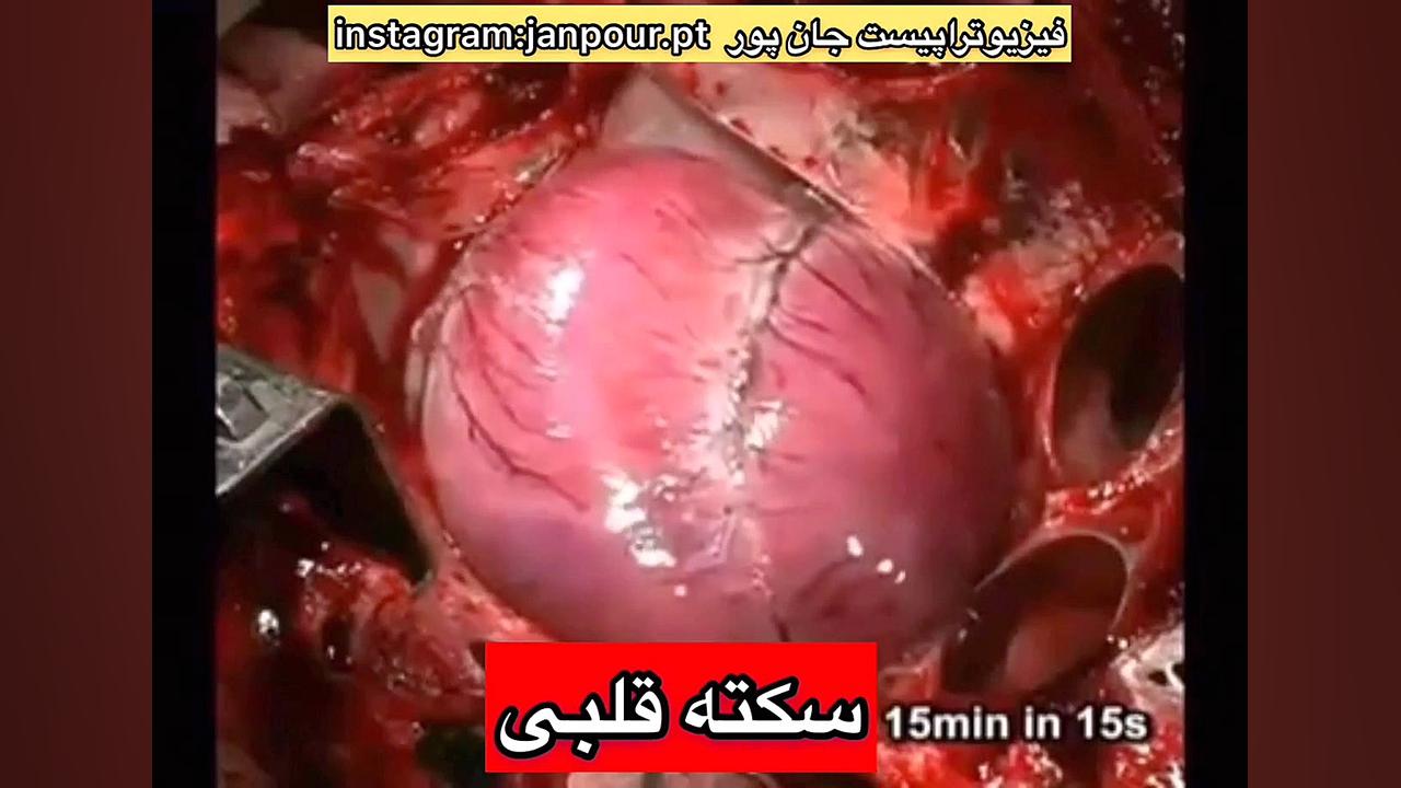 کلیپ سکته قلبی.کلینیک فیزیوتراپی در شمس آباد،شمیران نو،علم و صنعت 09122655648 کلینیک لیزر