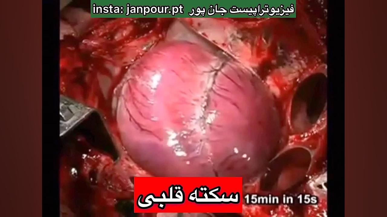 سکته قلبی پلاسماجت
