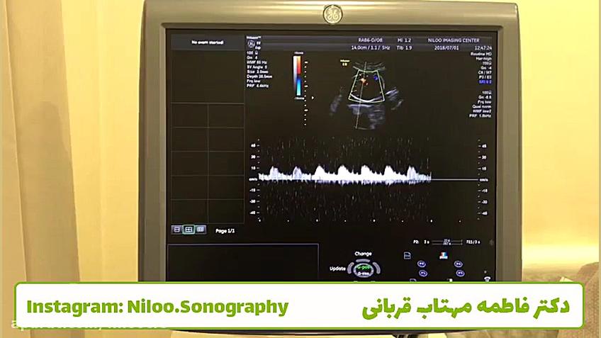 توضیح در مورد سونوگرافی کالرداپلر سونوگرافی نیلو دکتر فاطمه مهتاب قربانی