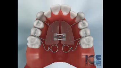 Quad Helix ( دستگاه عریض کننده فک بالا) دکتر سهیل سالاری