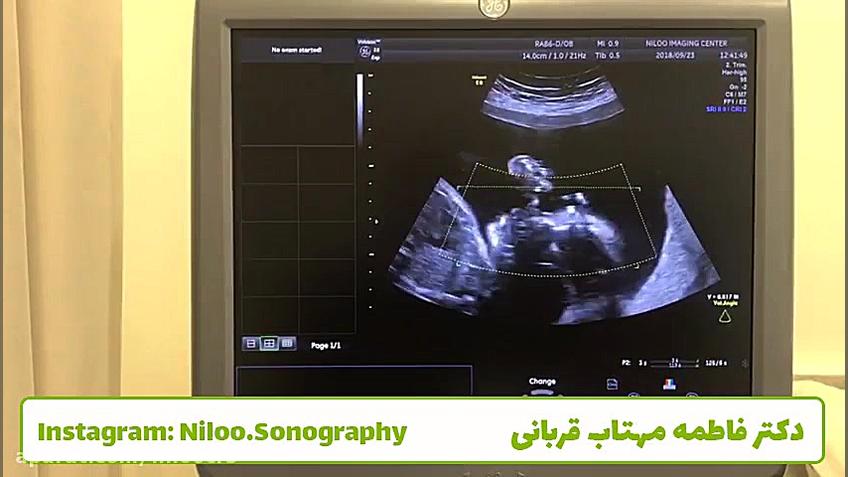 سونوگرافی جنین - محل عبور بند ناف سونوگرافی نیلو دکتر فاطمه مهتاب قربانی