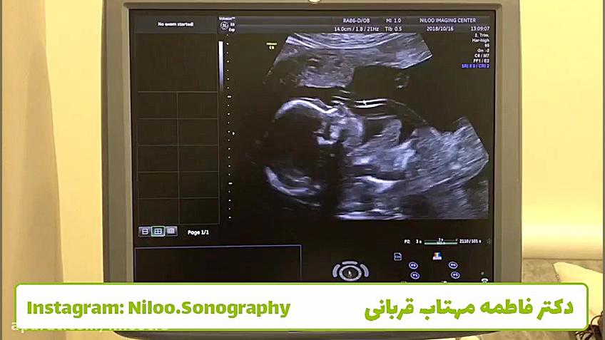 سونوگرافی و توضیح تعداد عروق بند ناف سونوگرافی نیلو دکتر فاطمه مهتاب قربانی