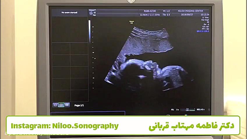 سونوگرافی جنین و کاهش مایع آمنیوتیک سونوگرافی نیلو دکتر فاطمه مهتاب قربانی