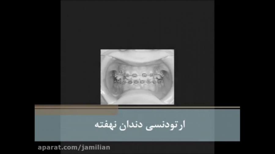 روند ارتودنسی و درمان دندان نهفته را ببینید دکتر عبدالرضا جمیلیان - متخصص ارتودنسی