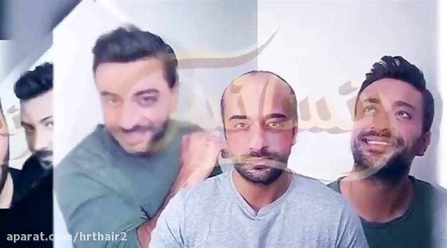 کاشت ریش و سیبیل