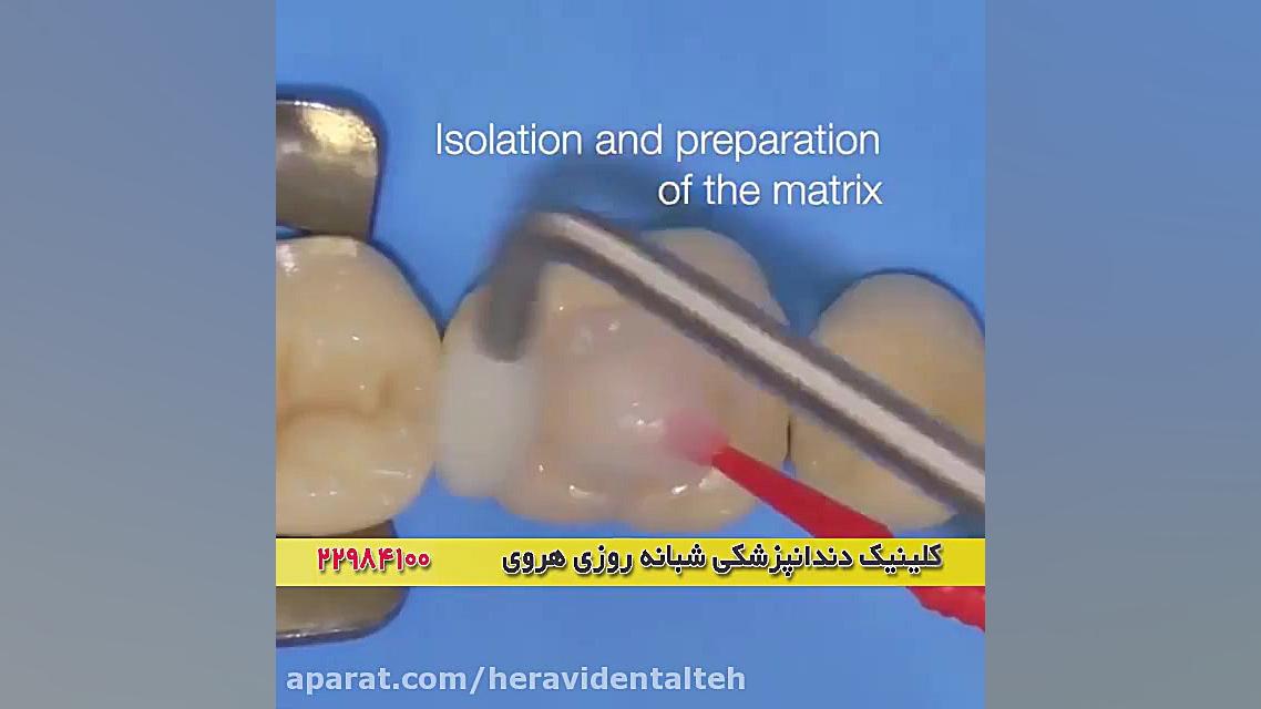 پیشگیری از پوسیدگی و خرابی دندان با ترمیم به موقع دندان علامت لاسگ