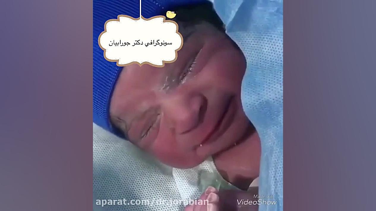 سونوگرافی جنین ابی