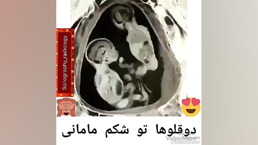 سونوگرافی جنین شتر موزیکال