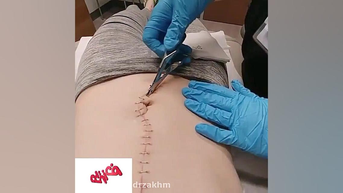 کشیدن بخیه استاپل جراحی در مرکز دکتر زخم تست لوسمی باقی‌مانده
