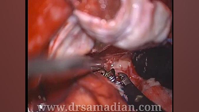 آنوریسم مغزی (سردردهای ناگهانی را جدی بگیرید) کاشت ابرو