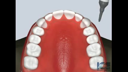 نحوه قرار دادن نگه دارنده ثابت (fixed retainer) دکتر سهیل سالاری