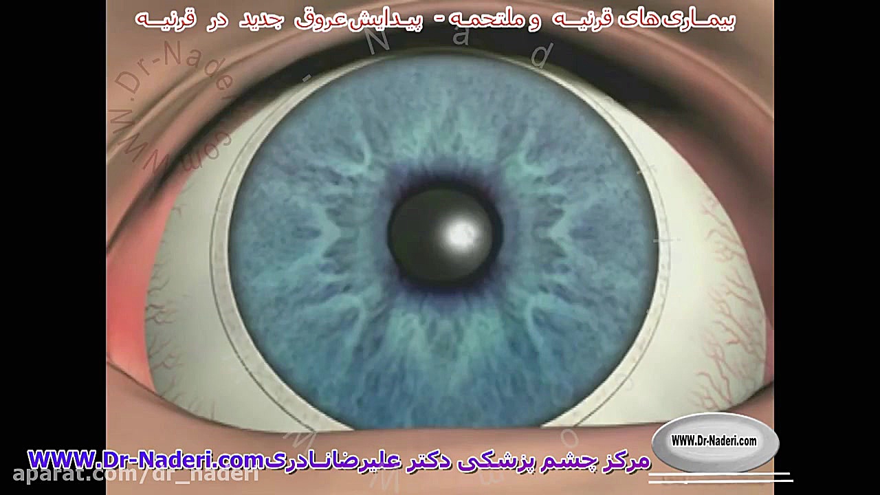 عروق غیرطبیعی قرنیه-مرکز چشم پزشکی دکتر علیرضا نادری مرکز چشم پزشکی دکتر علیرضا نادری www.dr-naderi.com