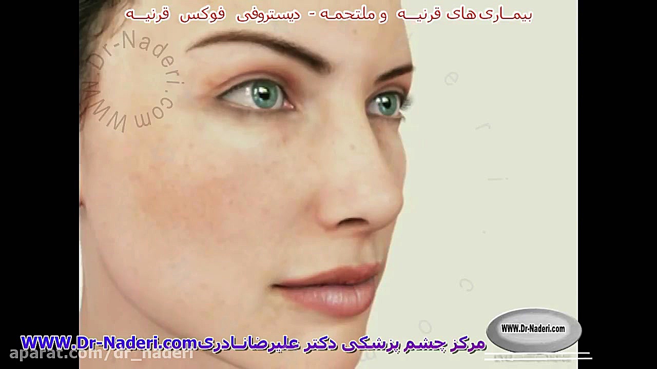 دیستروفی فوکس قرنیه - مرکز چشم پزشکی دکتر علیرضا نادری مرکز چشم پزشکی دکتر علیرضا نادری www.dr-naderi.com