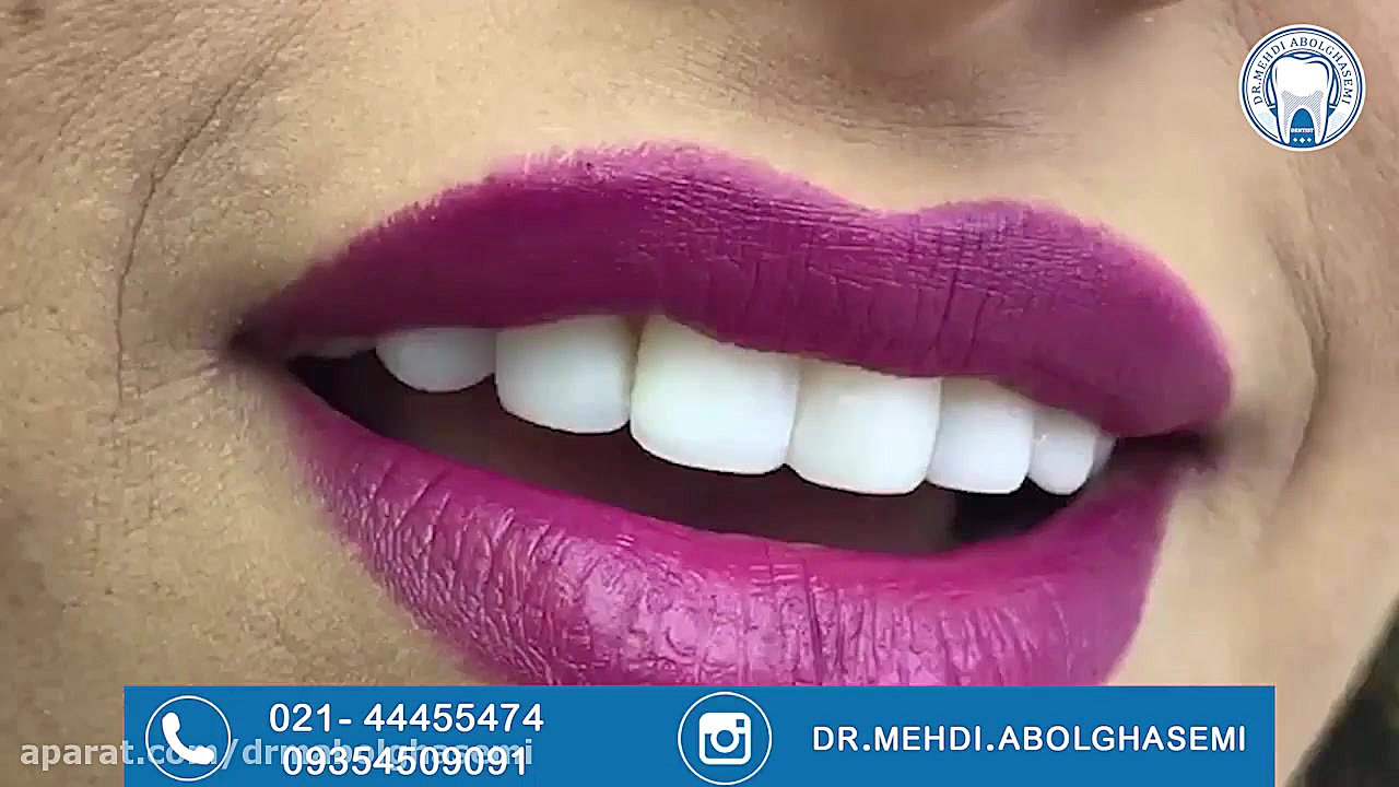 کامپوزیت ونیر سیستم ارزیابی هیستوترمیک