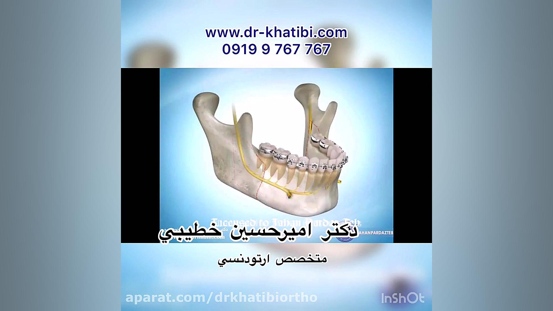 جراحی جلو آوردن فك پایین كوچك دکتر امیرحسین خطیبی