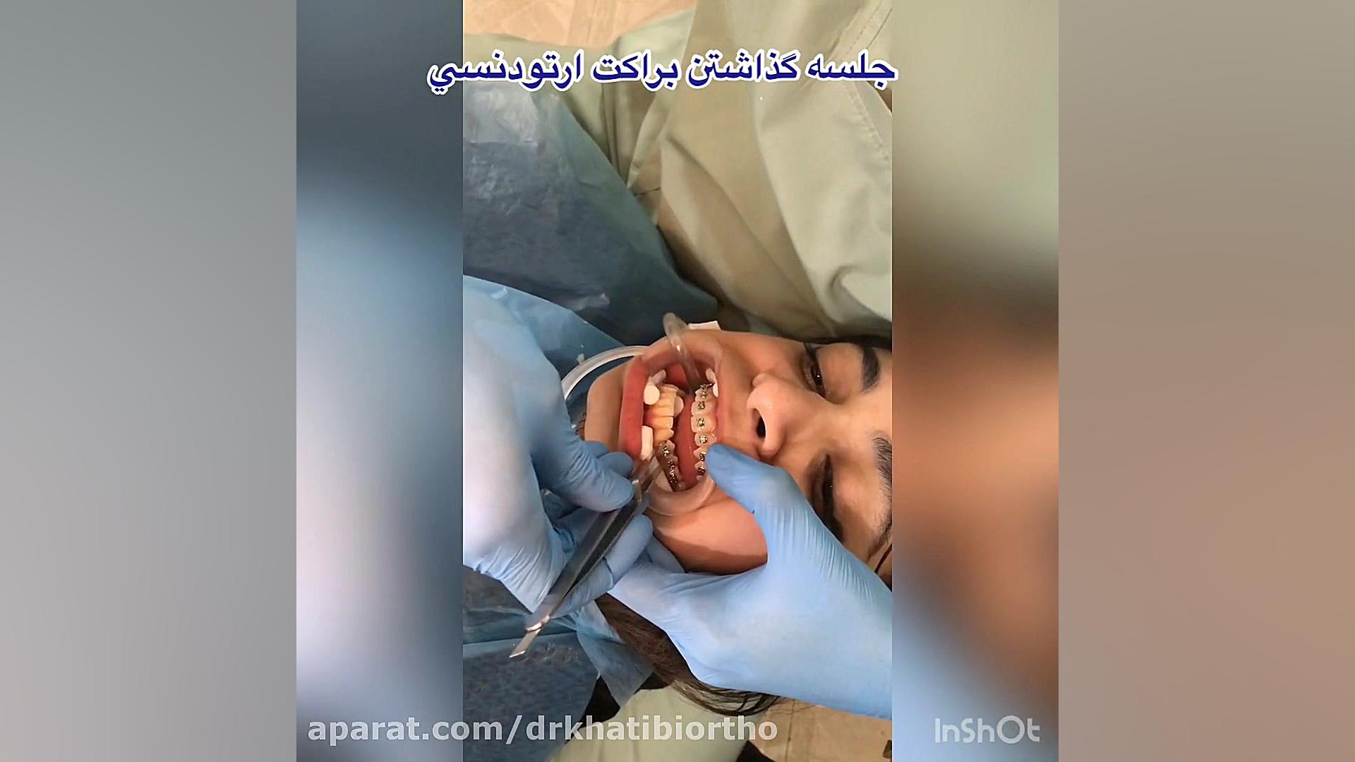 گذاشتن براكت هاي ارتودنسي دکتر امیرحسین خطیبی