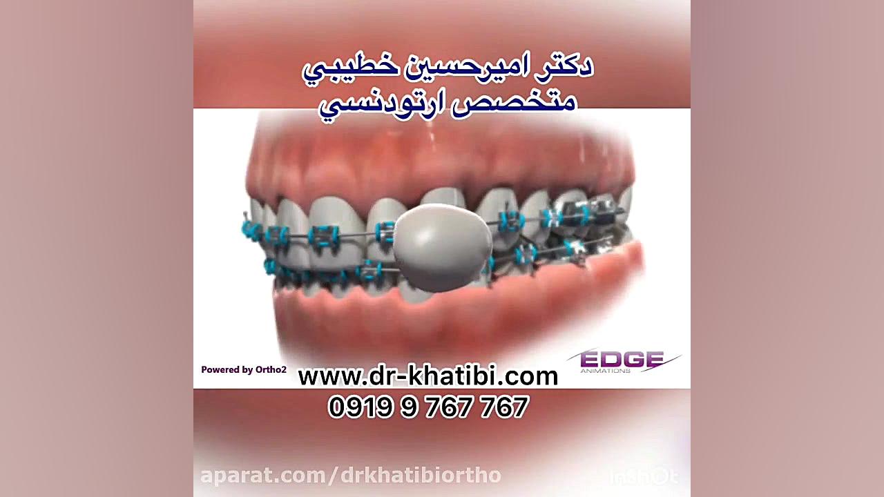 موم ارتودنسي دکتر امیرحسین خطیبی