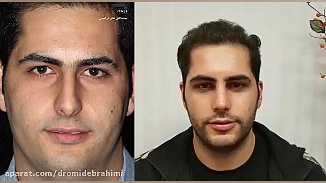 جراحی بینی استخوانی توسط دکتر امید ابراهیمی دکتر امید ابراهیمی