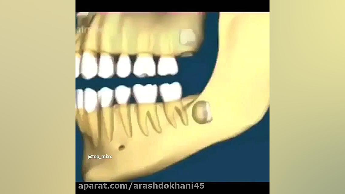 دندان عقل دکتر آرش دخانی