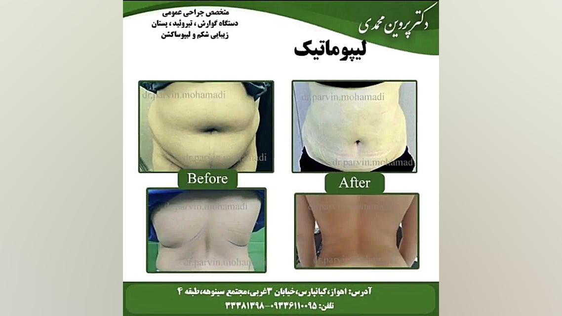پیکرتراشی لیپولیز لیپوماتیک ابدومینوپلاستی زاویه سازی صورت