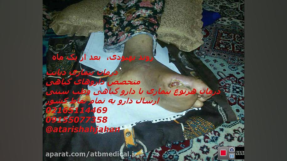 دیابت درمان شده جراحی گوش