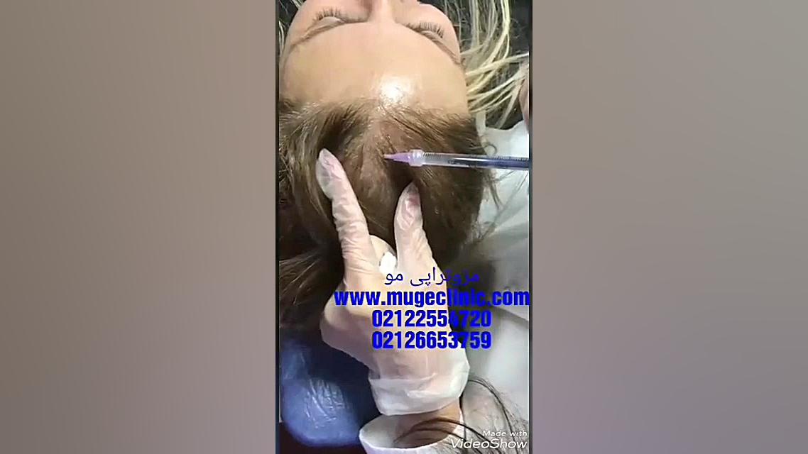 مزوتراپی مو برای درمان ریزش مو-موگه کلینیک توپوتیکان