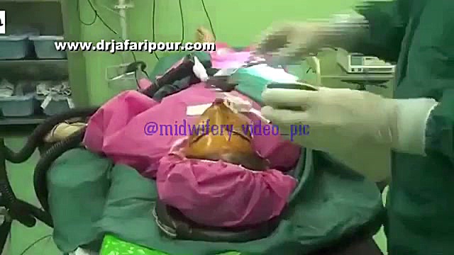 پروتز گونه برداشتن خال گوشتی