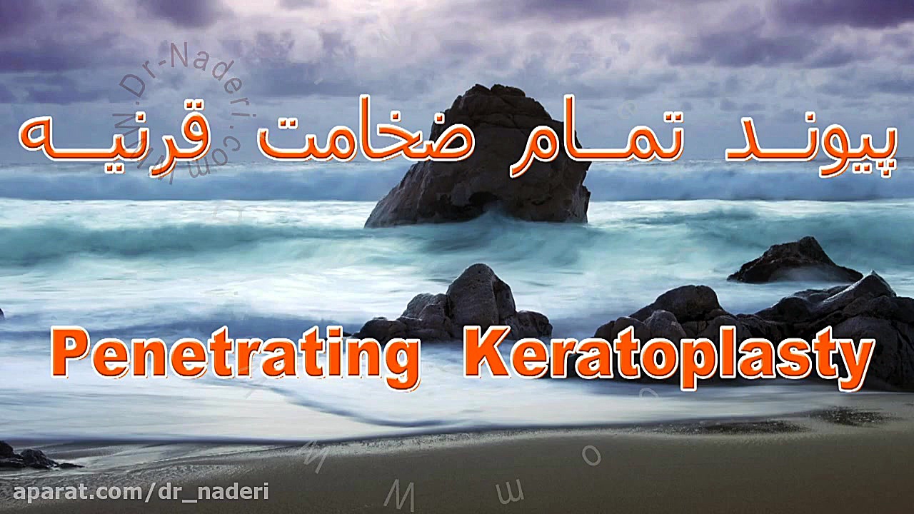 پیوند تمام ضخامت قرنیه - مرکز چشم پزشکی دکتر علیرضا نادری مرکز چشم پزشکی دکتر علیرضا نادری www.dr-naderi.com