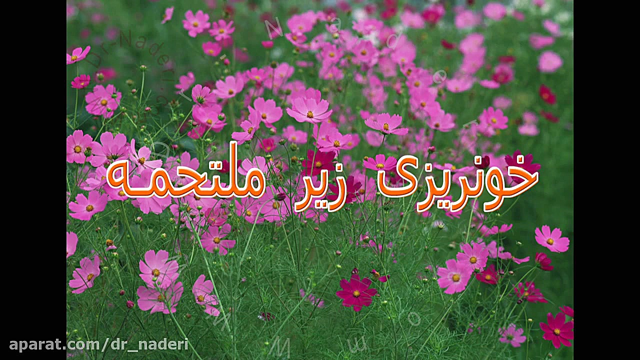 خونریزی زیر ملتحمه چشم-مرکز چشم پزشکی دکتر علیرضا نادری مرکز چشم پزشکی دکتر علیرضا نادری www.dr-naderi.com