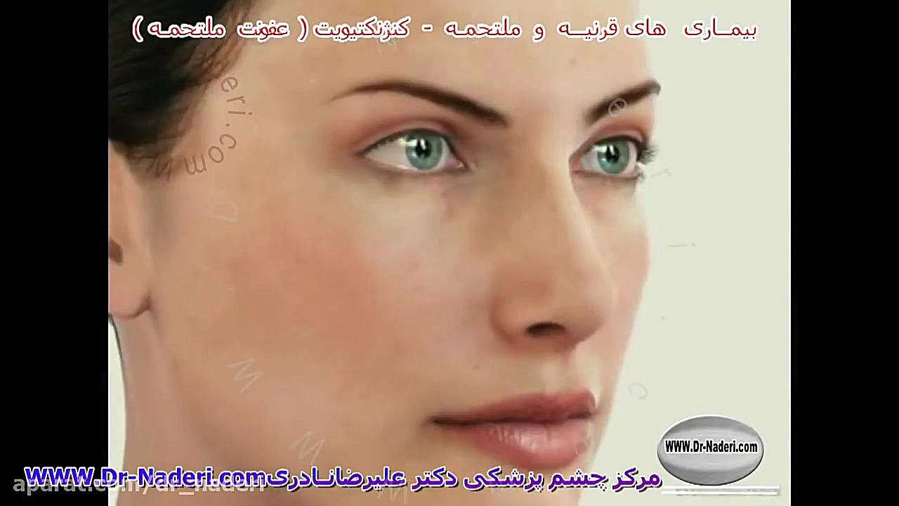 کنژنکتیویت یا عفونت ملتحمه - مرکز چشم پزشکی دکتر علیرضا نادری مرکز چشم پزشکی دکتر علیرضا نادری www.dr-naderi.com