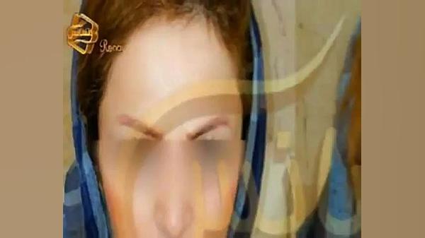 فیلم کاشت ابرو طبیعی با روش SUT مرکز کاشت مو هایپوفلکسی