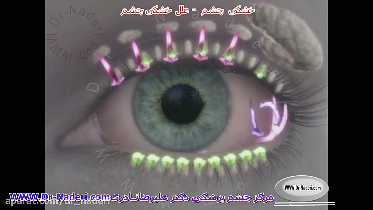 عوامل زمینه ساز خشکی چشم -مرکز چشم پزشکی دکتر علیرضانادری مرکز چشم پزشکی دکتر علیرضا نادری www.dr-naderi.com