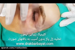 تخلیه ژل از اطراف چشم در معتبر...