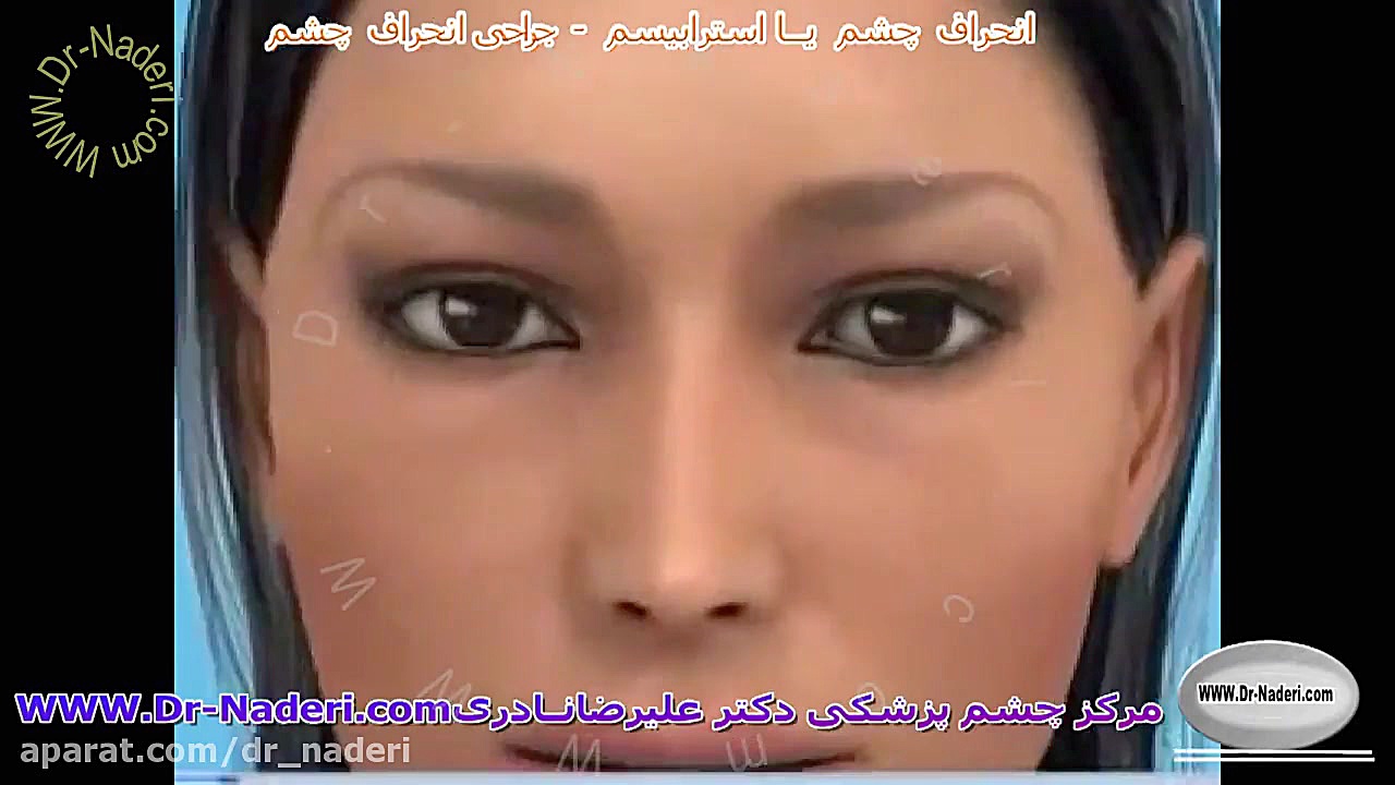 عمل جراحی انحراف چشم - مرکز چشم پزشکی دکتر علیرضا نادری پزشکی درد مداوم