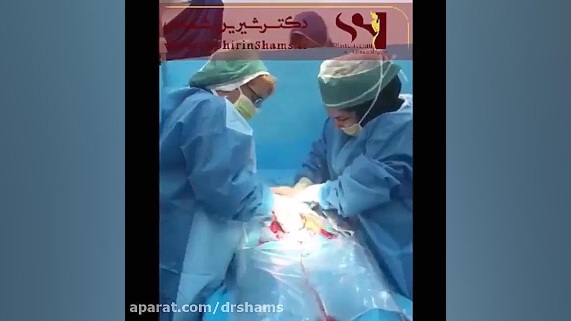 زایمان سزارین دکتر شیرین شمس جراح و متخصص زنان و زایمان