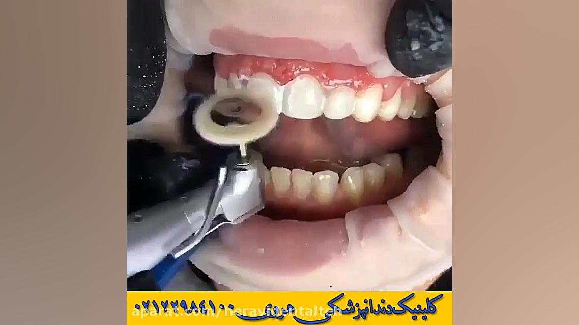 اصلاح لبخند لثه ای درمان کامپوزیتی برای دندان های قدامی آزمایش بلوغ ریوی جنین