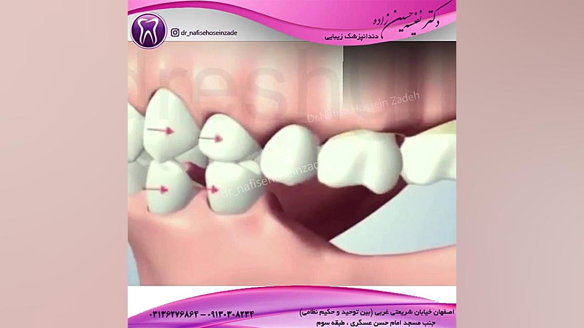 ایمپلنت دندان بیماری کارنی تین ناقل نقص اولیه
