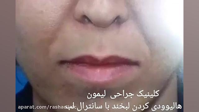 زیباتر کردن چهره با جراحی لیفت لب توسط بهترین جراح لب تهران جرمگیری