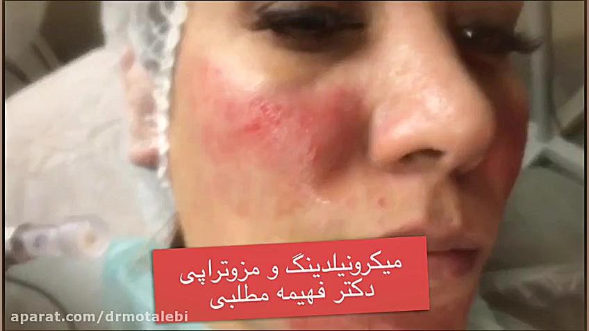میکرونیدلینگ و مزوتراپی هپاتواسپلنومگالی