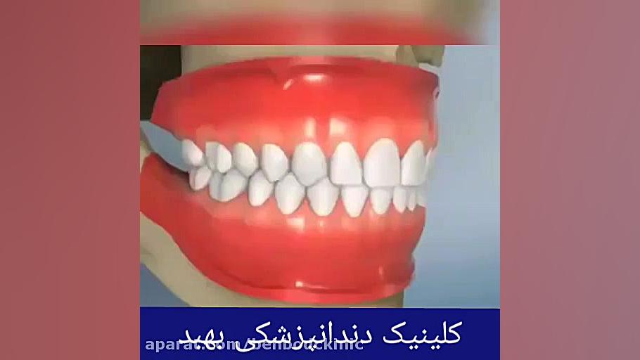 پرکردن دندان میوکلونوس