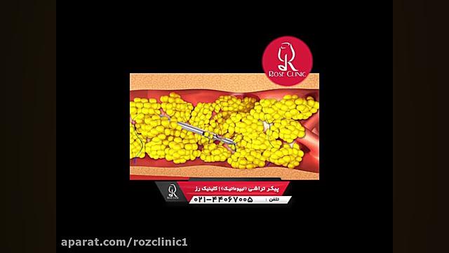 لیپوماتیک | فیلم لیپوماتیک | عمل لیپوماتیک | کلینیک پوست و مو رز | شماره 2 کلینیک زیبایی
