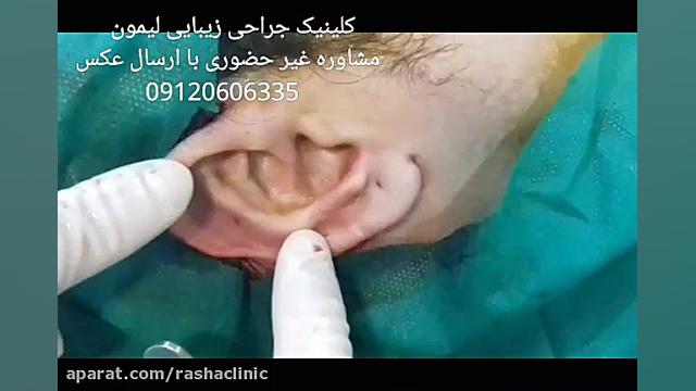 اصلاح موقعیت گوش بر روی سر به همراه فرم دهی لیفت صورت