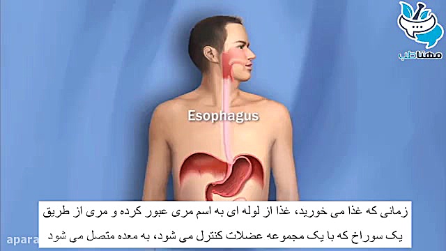 علت ترش کردن و ریفلاکس معده برداشتن خال
