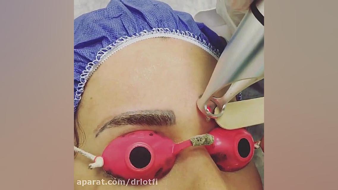 لیزر پاک کردن تاتو ابرو دکتر سار ا لطفی
