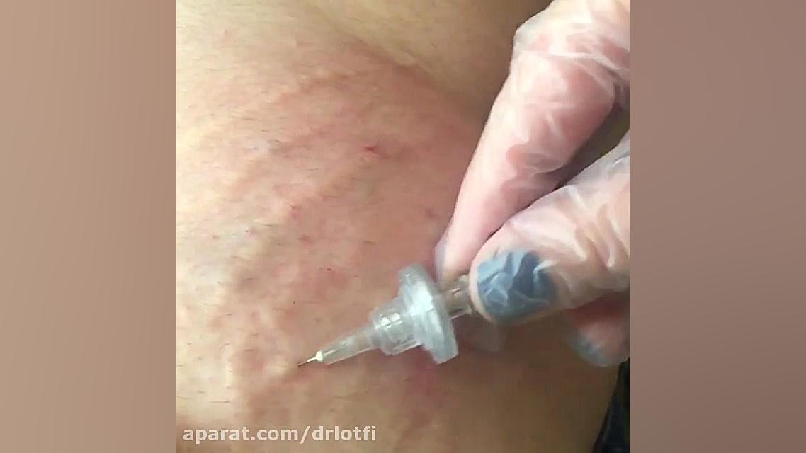 کربوکسی تراپی دکتر سار ا لطفی